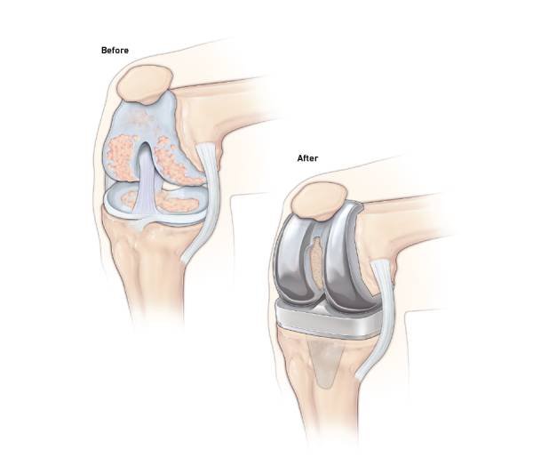 Knee Arthiritis